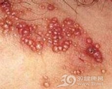 皮肤黏液瘤