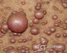 皮肤神经瘤
