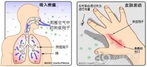 皮肤炭疽