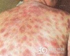 皮肤T细胞淋巴样增生