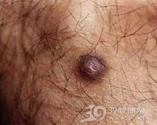 皮肤纤维瘤
