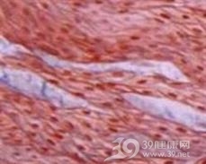 平滑肌错构瘤