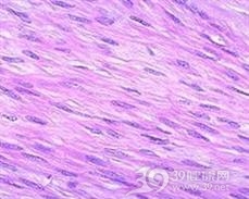 平滑肌瘤