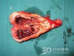 平滑肌肉瘤