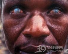 盘尾丝虫病