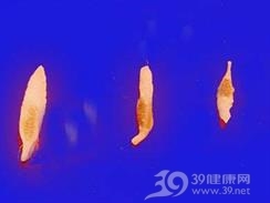 片吸虫病