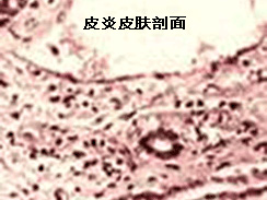皮炎