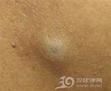 皮样表皮样囊肿