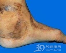 皮炎芽生菌