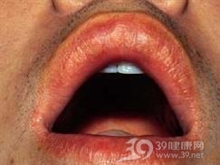 皮脂腺异位症