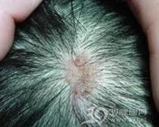 皮脂腺痣