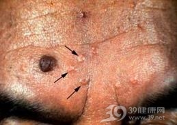 皮脂腺增生