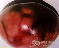 脾脏原发性恶性肿瘤