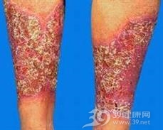 疱疹样脓疱病
