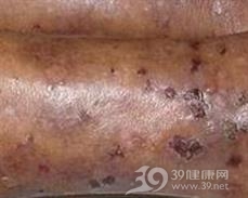 疱疹样皮炎