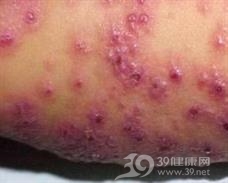 疱疹样湿疹