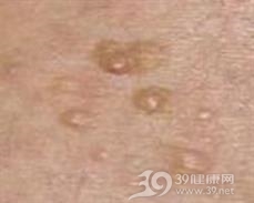 浅表性皮肤脂肪瘤痣