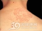 球孢子菌病
