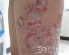 钱币状湿疹