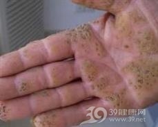 钱币状掌跖角化病