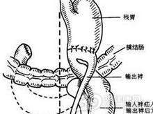 切除术后内疝