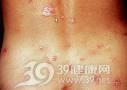 潜伏梅毒
