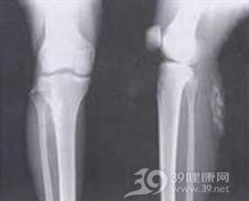 羟磷灰石沉积病