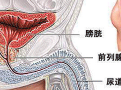前列腺钙灶化灶
