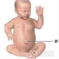 脐膨出-巨舌-巨大躯体综合征
