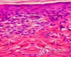 气球状细胞痣