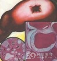 气性坏疽