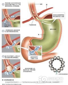 器械性食管损伤