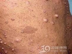 侵袭性婴儿纤维瘤病