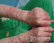 千足虫灼伤