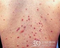 丘疹坏死性结核疹