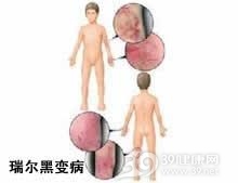 瑞尔黑变病