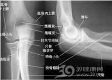 桡骨颈骨折