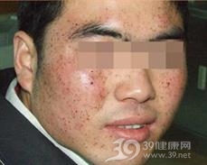 日光性雀斑样痣