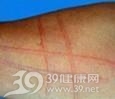 皮肤划痕症
