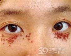 软骨样汗管瘤