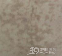融合性网状乳头瘤病