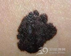 肉瘤皮肤转移