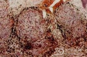 人免疫缺陷病毒感染性肾损害