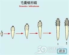 人蠕形螨病