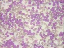 妊娠合并获得性免疫缺陷综合征