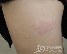 妊娠疱疹