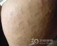 妊娠痒疹
