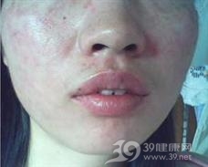 人为性皮炎
