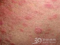 人为脂膜炎
