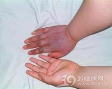 蔬菜皮炎